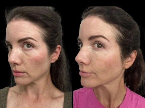 Preventing Early Aging Signs with Dark Circles Treatment in Dubai