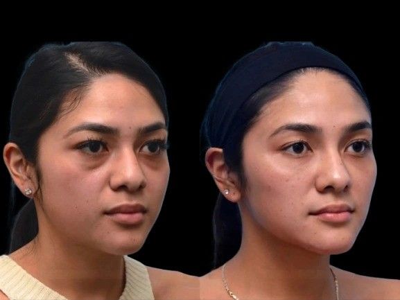 Safe and Reliable Options for Dark Circles Treatment in Dubai